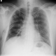 Spontanpneumothorax