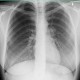 Spontanpneumothorax (Mantelpneu)