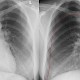 Spontanpneumothorax (Mantelpneu)