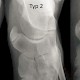 Os tibiale externum
