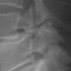 Spondylolisthese (Wirbelgleiten)