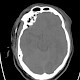 Schädel-Hirn-Trauma nach Verkehrsunfall