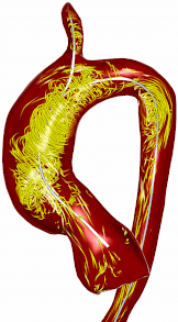 Verwirbelungen des Blutflusses als Folge der pathologisch geweiteten Aorta dieses Patienten.
