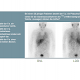 Tumorszintigraphie mit 123-J-mIBG